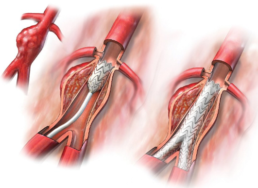 foto-de-protese-vascular-em-aneurisma-da-aorta-abdominal